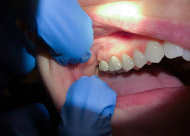 Best Broken or Cracked Tooth Emergency Dentist in Akron, NY